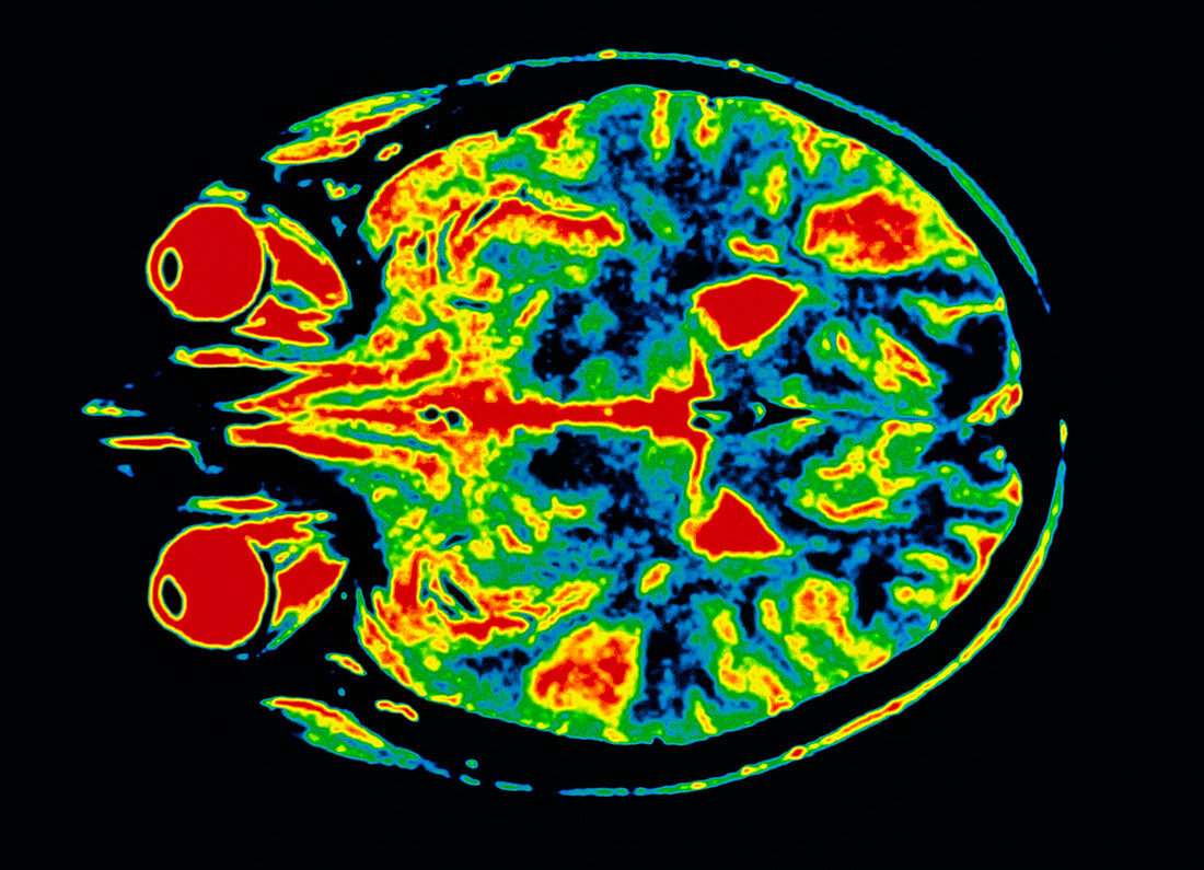 Colour MRI scan of a brain with multiple sclerosis