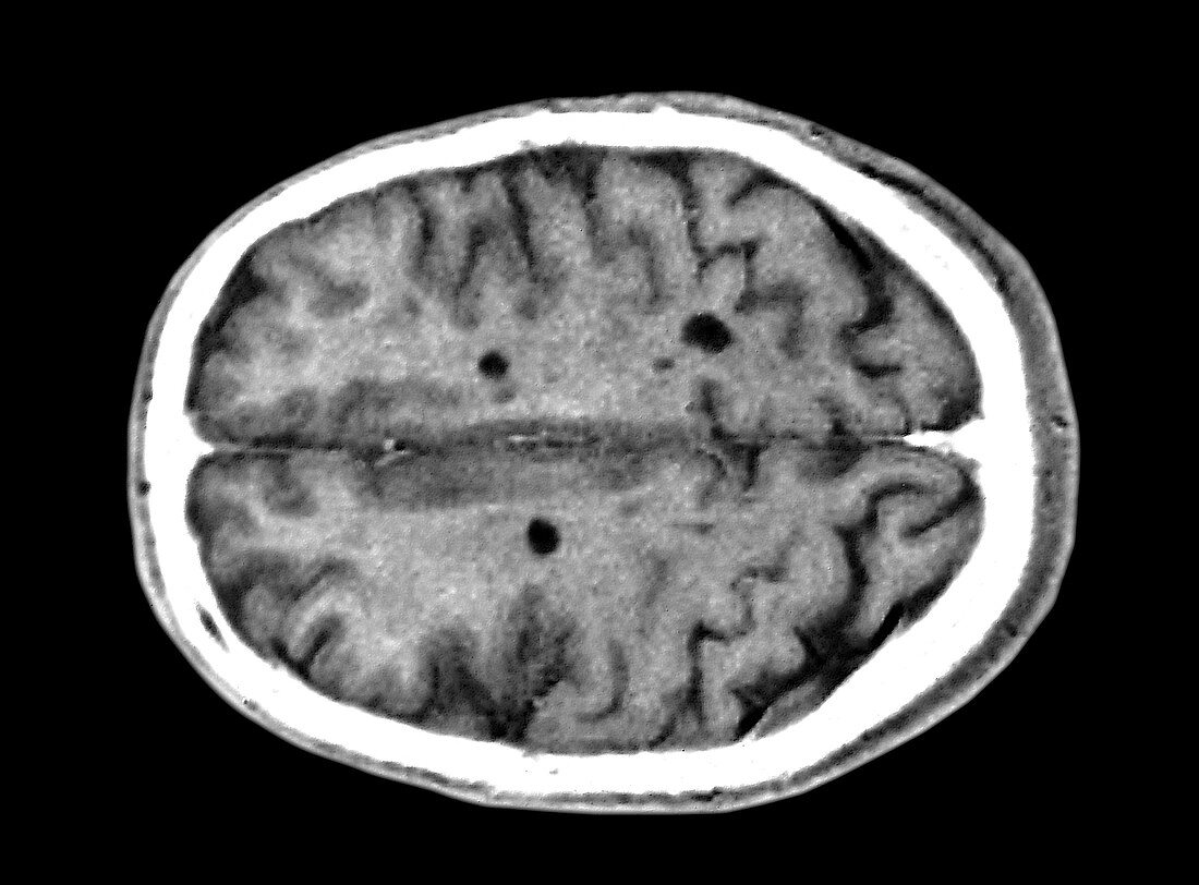 Multiple sclerosis brain lesions