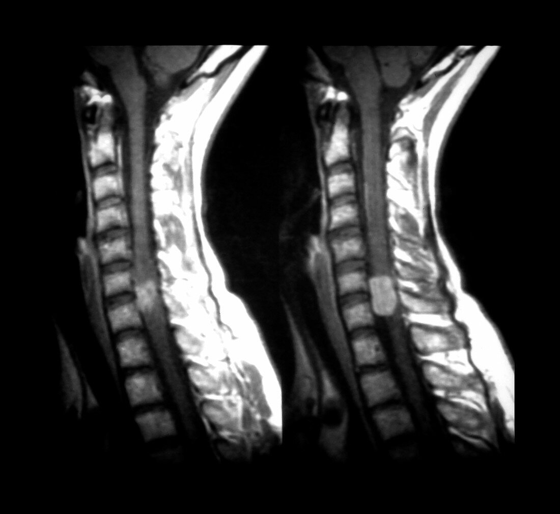 MRI of a Spinal Meningioma