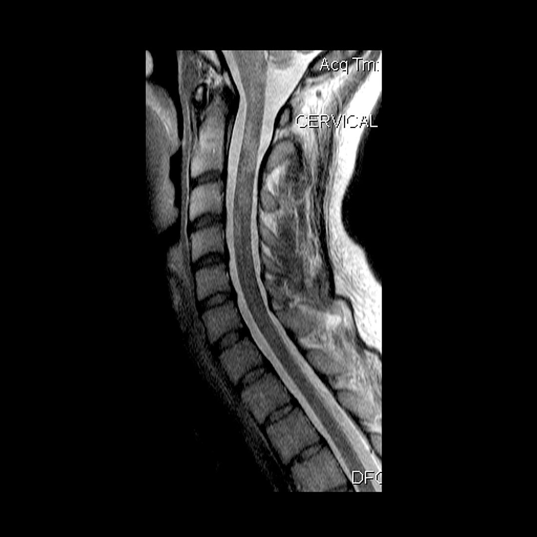 MS Cervical Spinal Cord