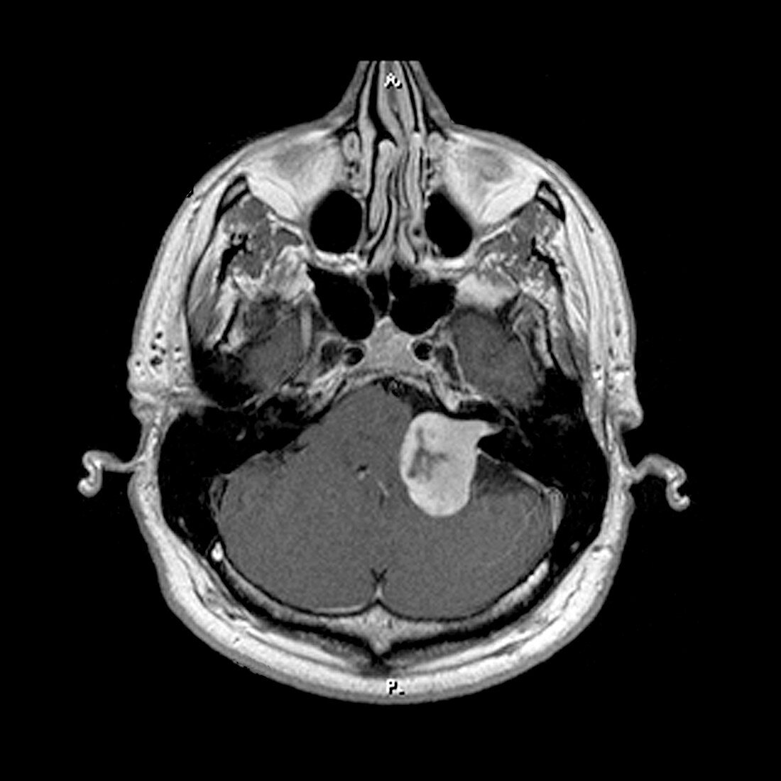 MRI of Acoustic Schwannoma