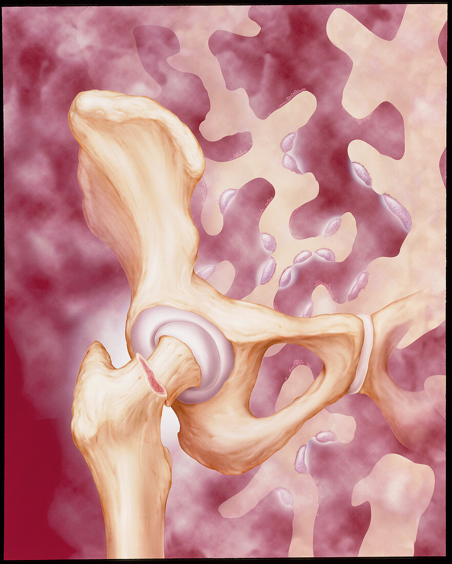 Artwork of a femur fracture due to osteoporosis
