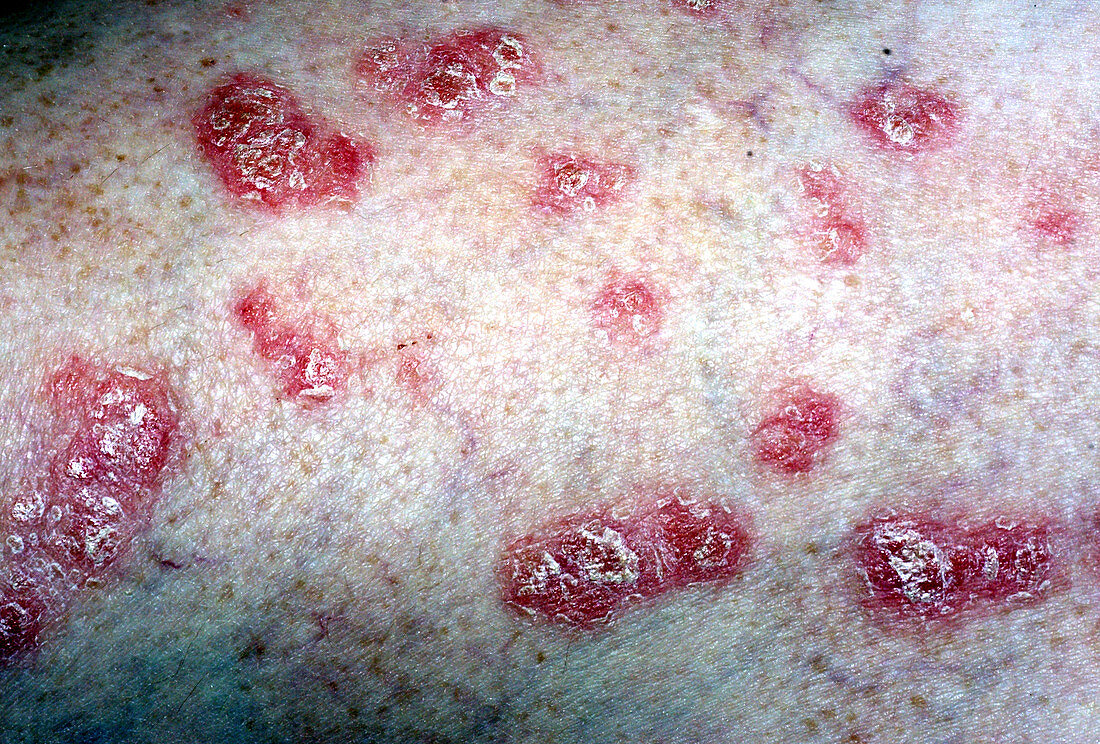 Psoriasis in a 43 Year Old Female
