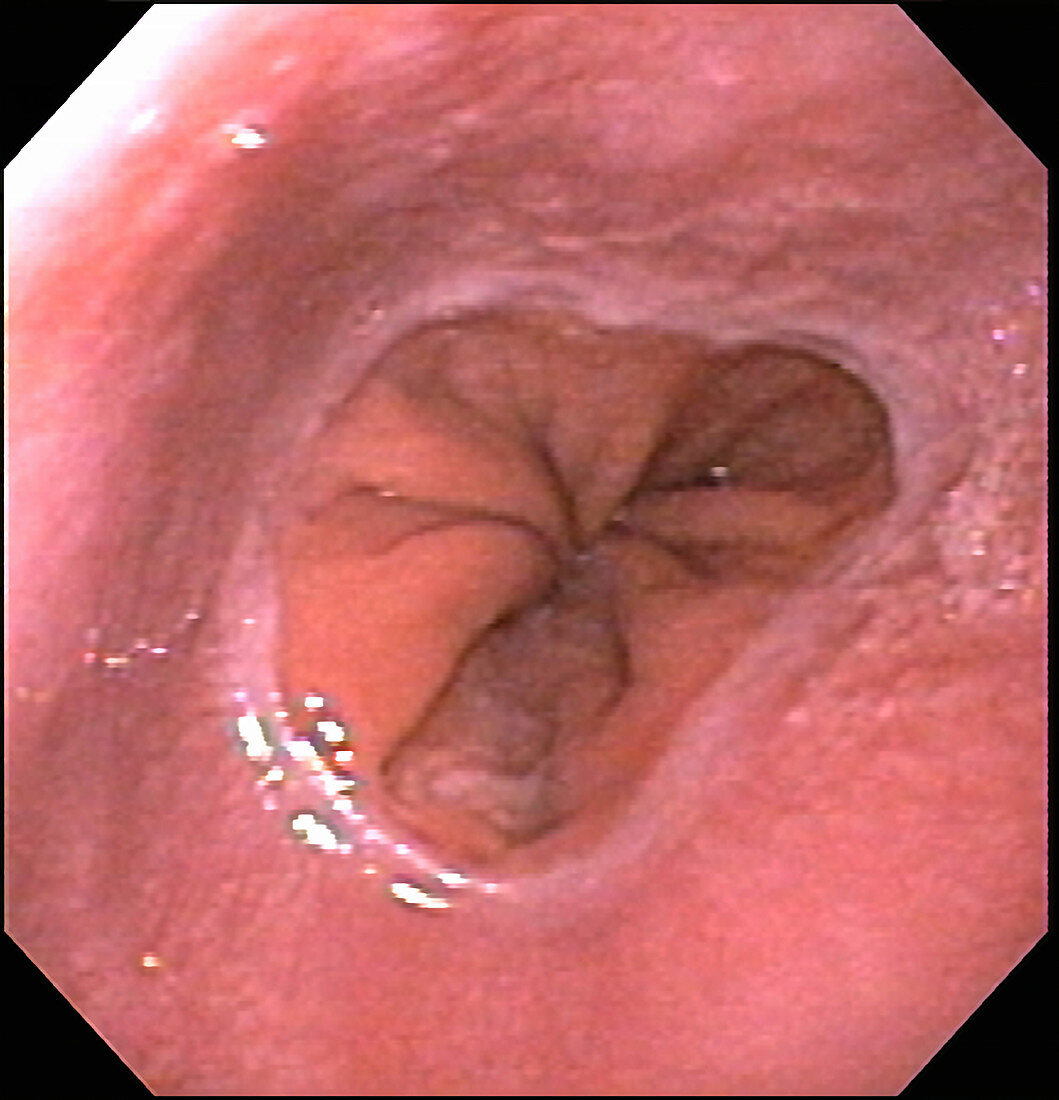 Hiatal Hernia