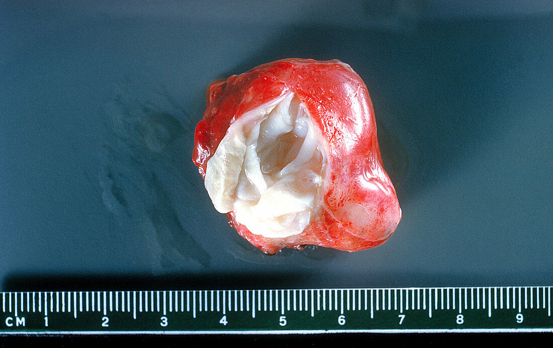 Hydatid Cyst From a Human Lung