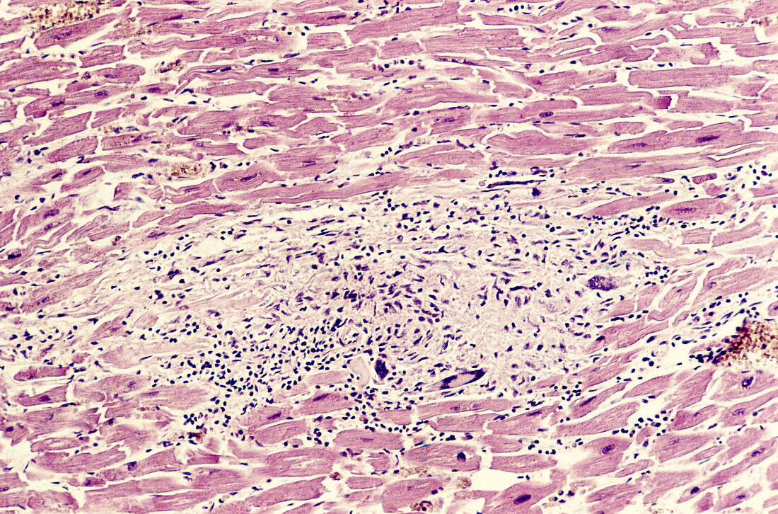 Granulomatous Myocarditis