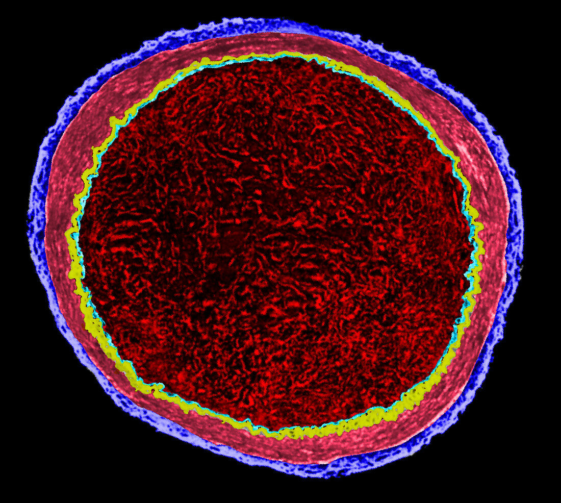 Arterial embolus