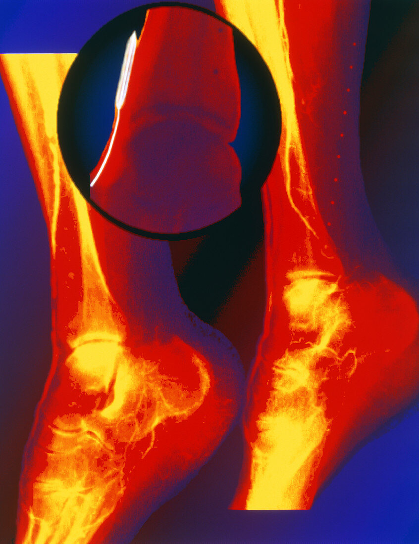 Coloured angiogram of balloon angioplasty in leg