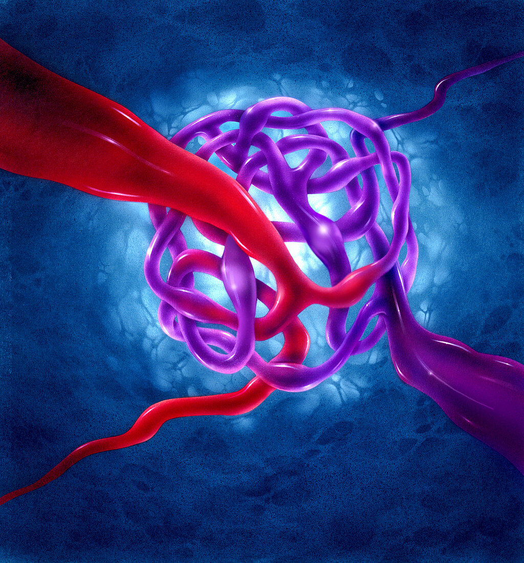 Illustration of arteriovenous malformation