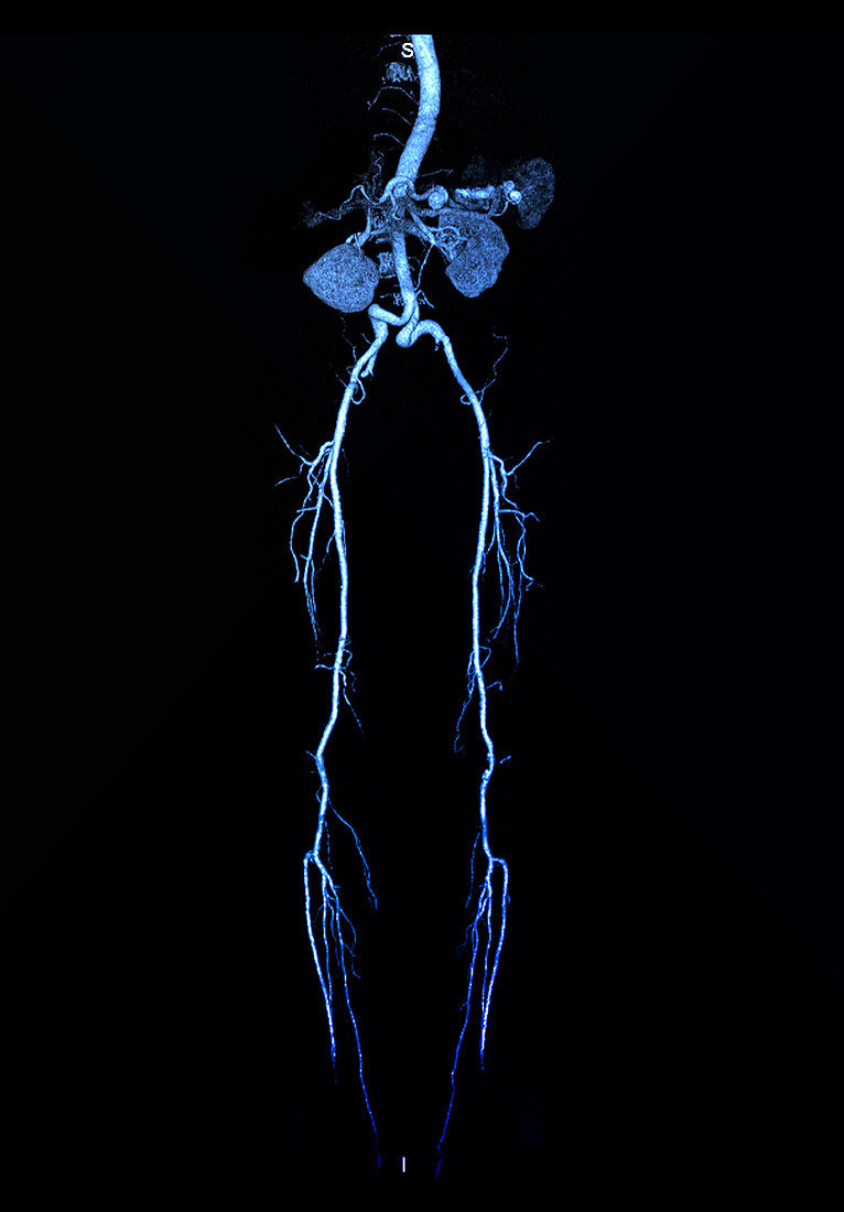 Sprial CT angiogram