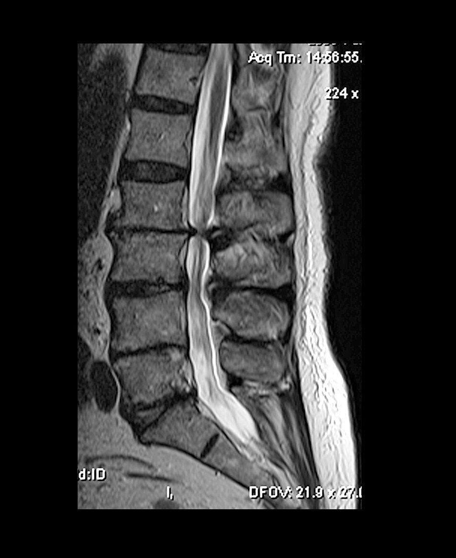Severe Spinal Stenosis