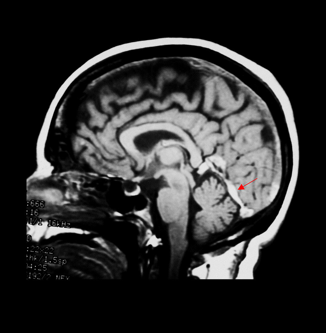MRI of Dural Sinus Thrombosis