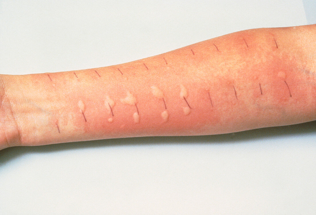 Allergy testing:patients arm showing skin reaction