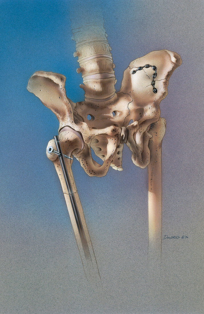 Artwork showing femur and ilium fracture repairs