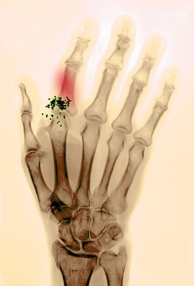 Gunshot wound,X-ray
