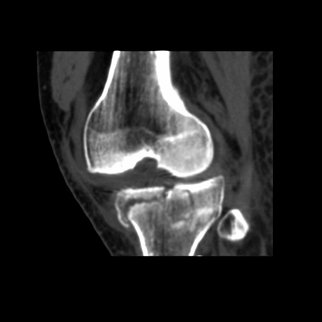 Computer Reconstruction of the Knee