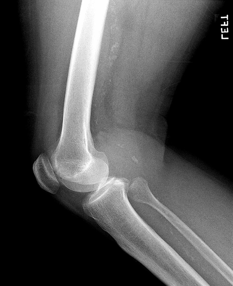 Lateral X-Ray of the Knee