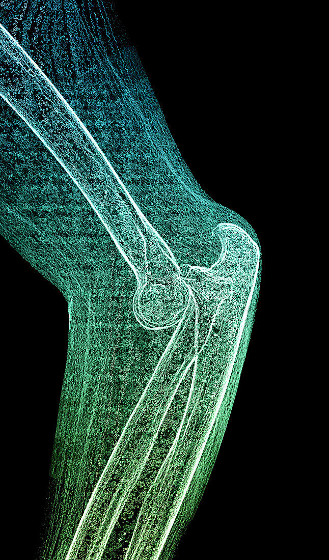 colour-Enhanced Lateral X-Ray of the Elbow