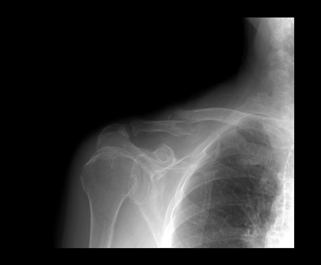 X-ray of acute fracture of the clavicle