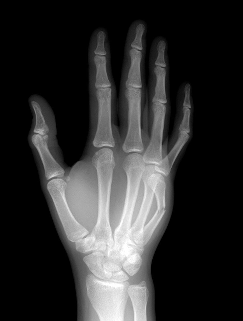 Fracture of the Hand
