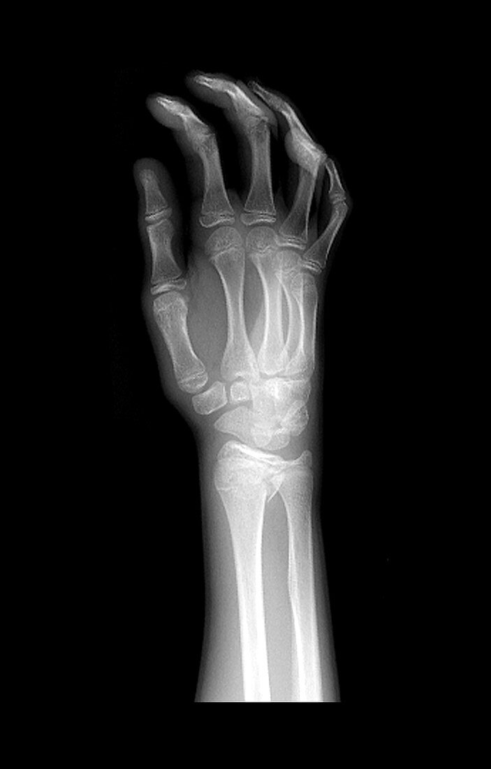 Wrist fracture