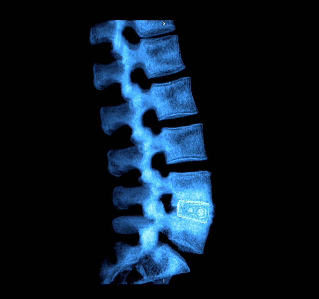 Lumbar Spine with Fusion Cages