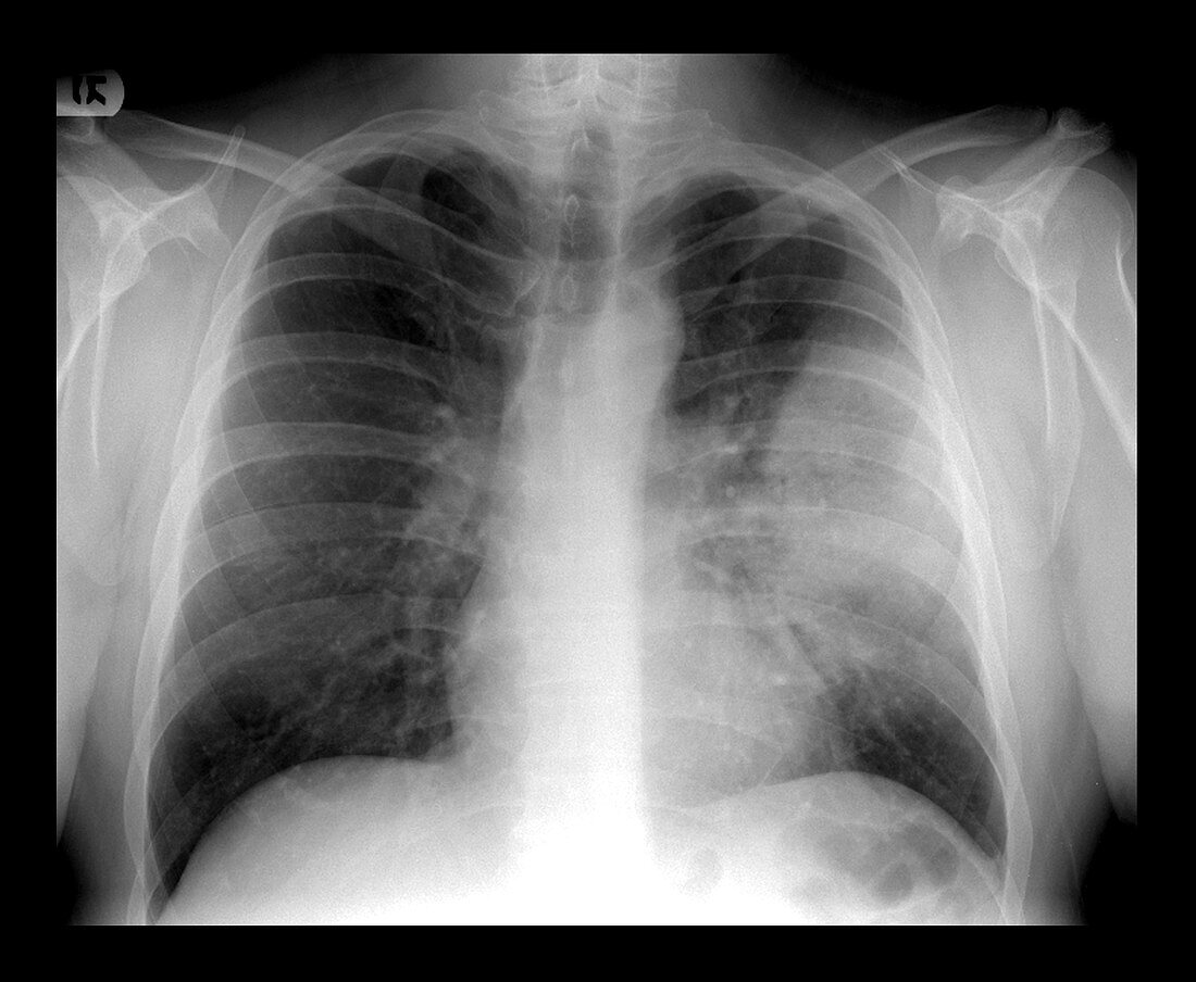 Lobar Pneumonia on Chest X-ray
