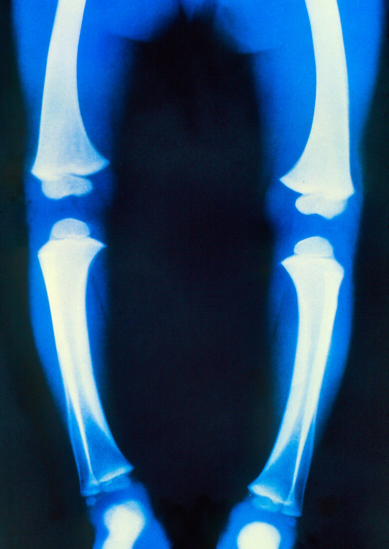 Coloured X-ray of the legs of a child with rickets