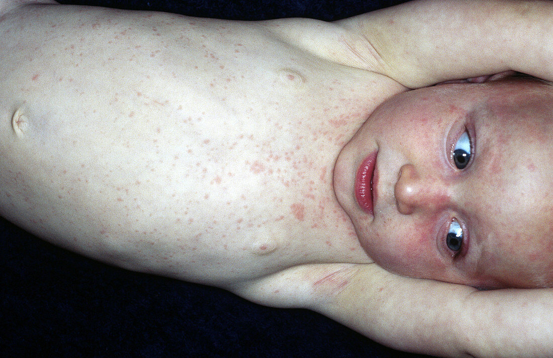 Roseola Infantum- viral rash