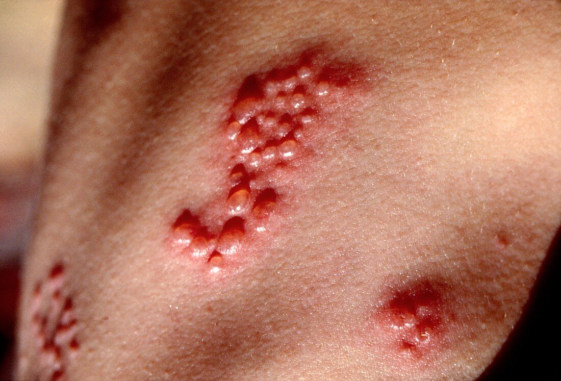 Herpes zoster: shingles rash across the skin