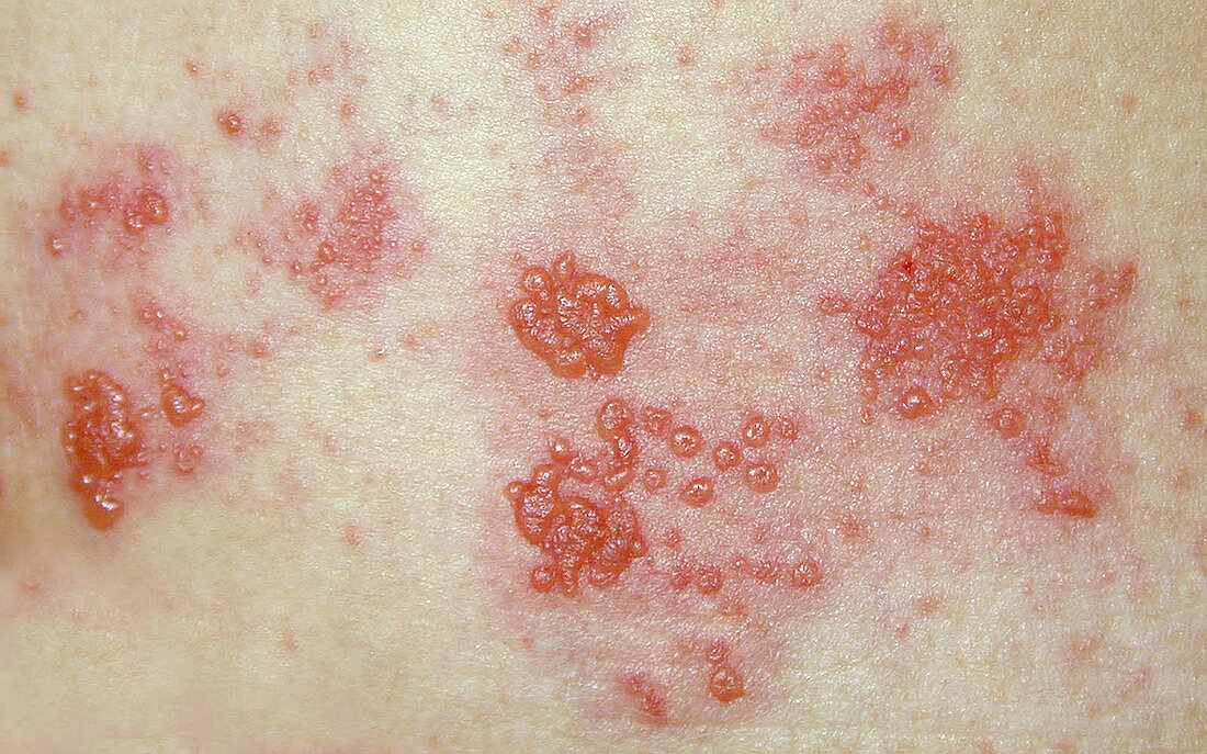 Herpes zoster rash
