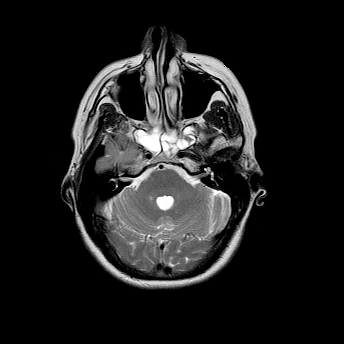 Sinusitis