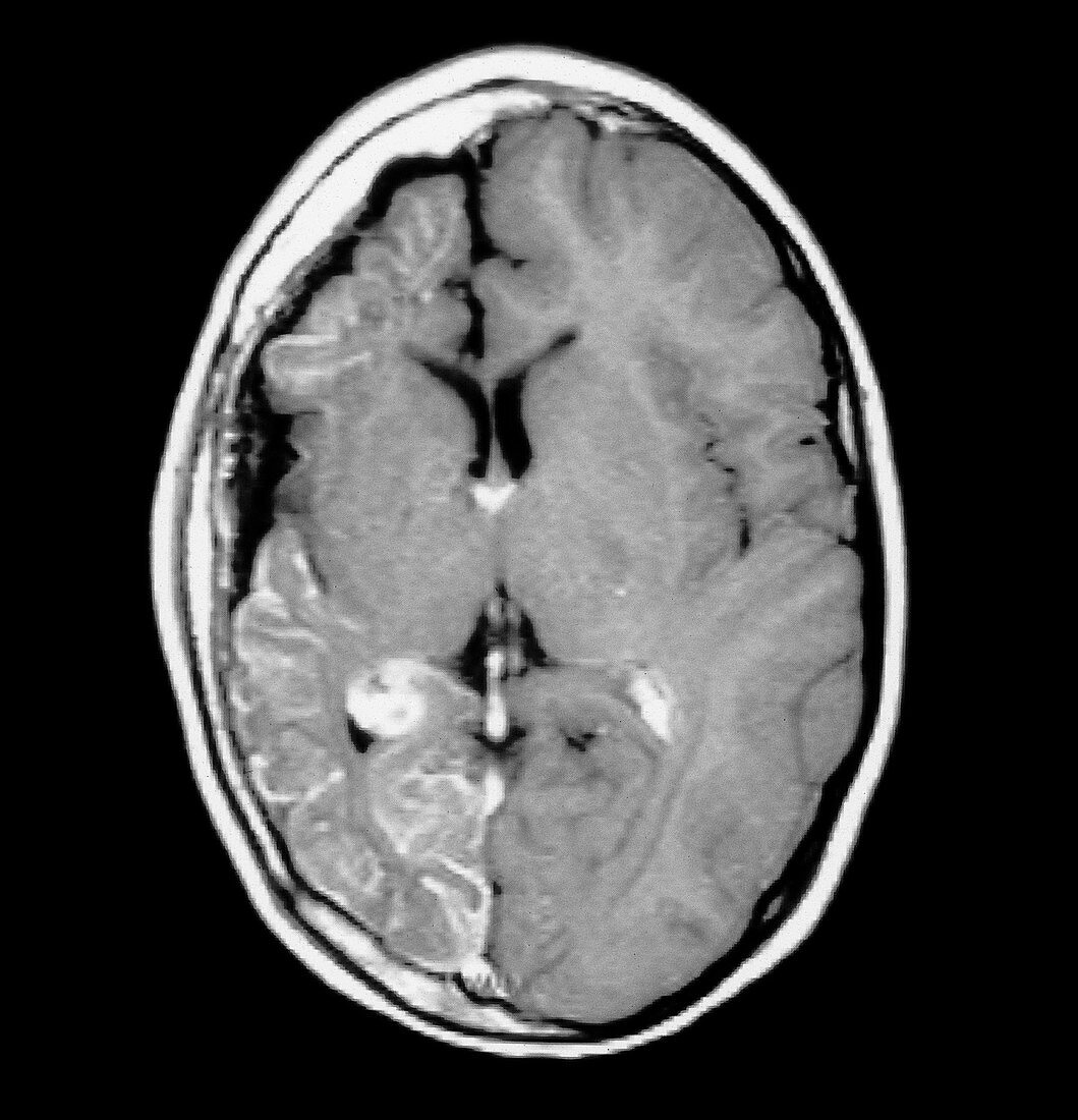 MRI of Sturge-Weber Syndrome