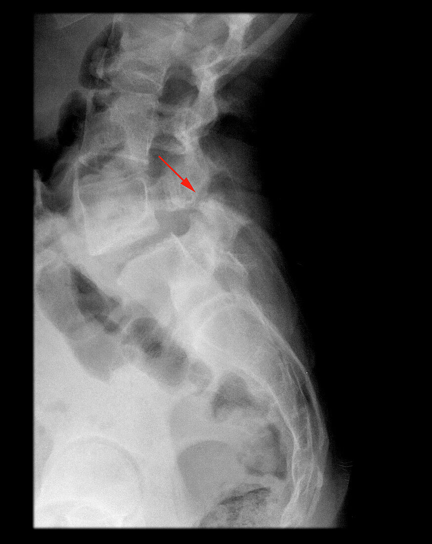 Spondylolysis