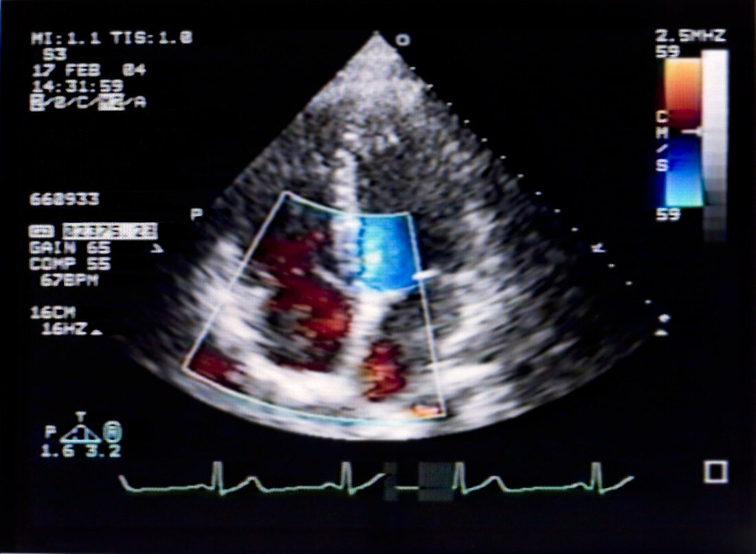 Doppler Echocardiogram of Heart