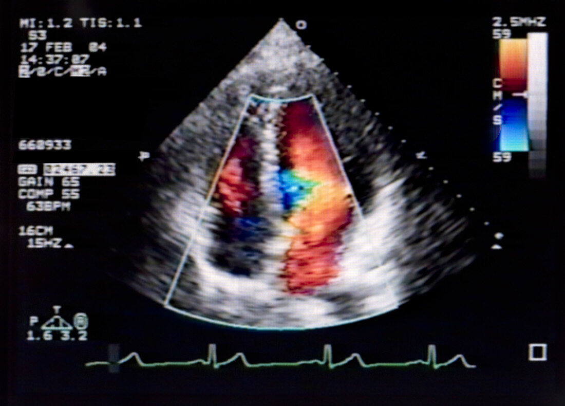 Doppler Echocardiogram of Heart