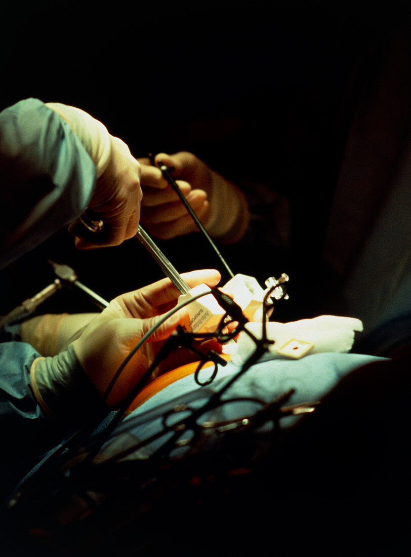 Surgeon using laparoscope