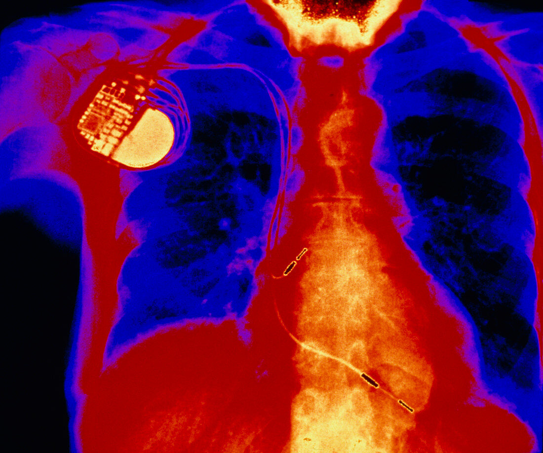 Coloured X-ray of chest with pacemaker implant