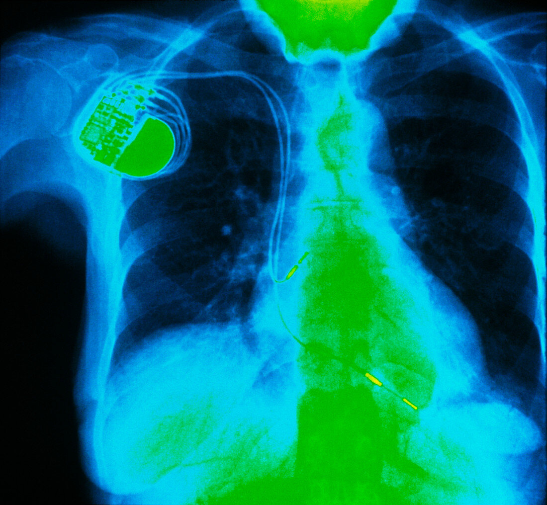 Coloured X-ray of double-chamber pacemaker in situ