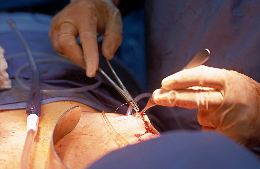 Suturing