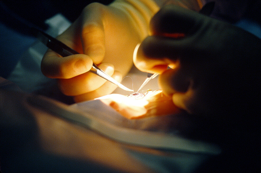 Surgeon suturing new cornea onto eye