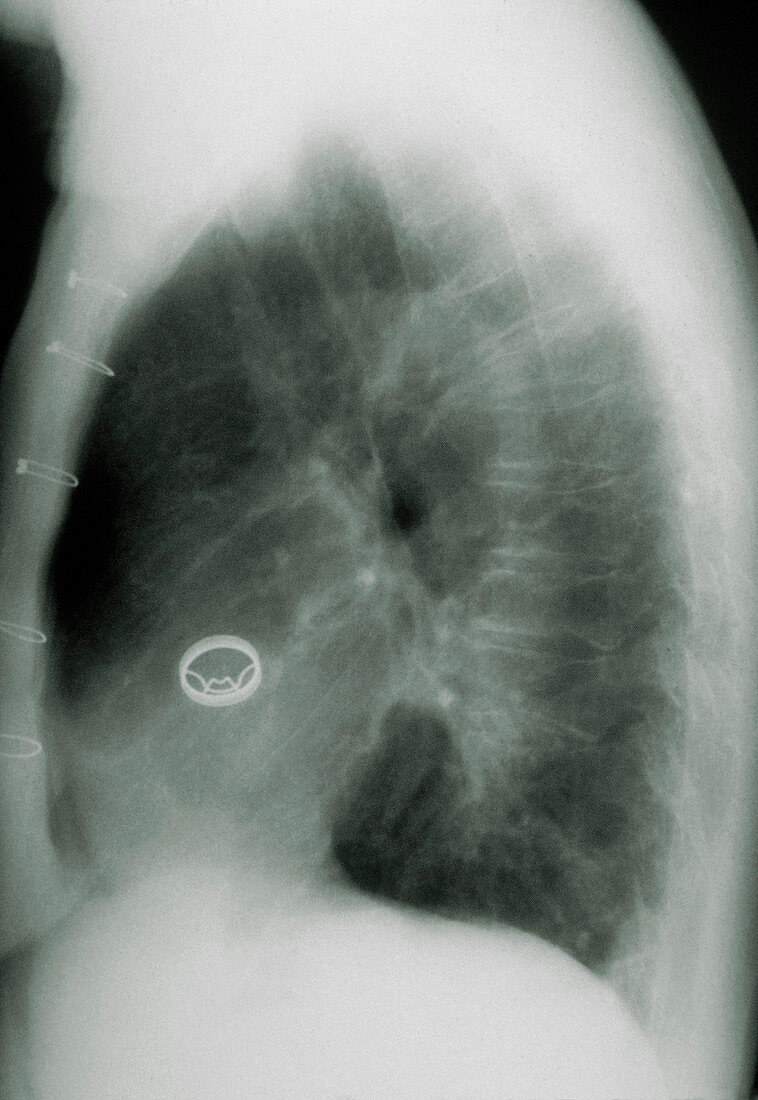 X-ray of chest showing artificial heart