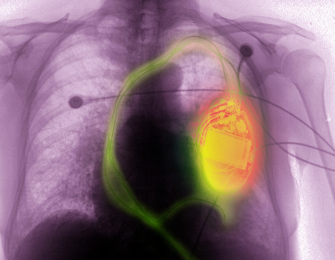 X-ray of man with pacemaker defibrillator
