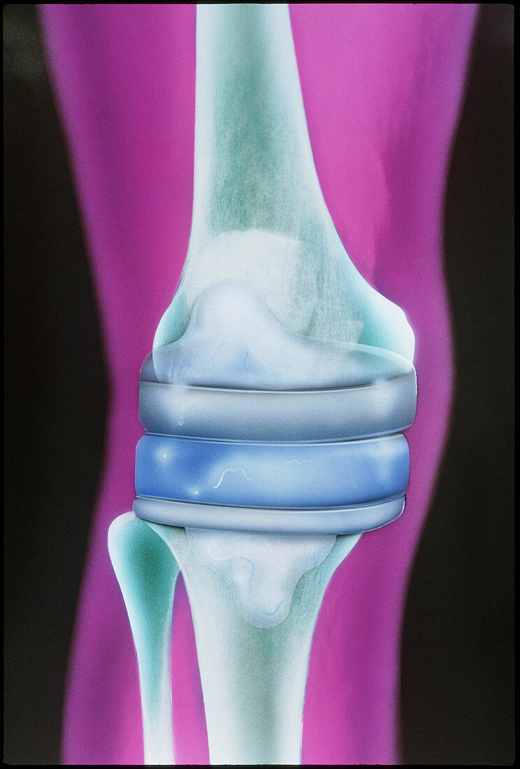 Illustration based on X-ray of an artificial knee