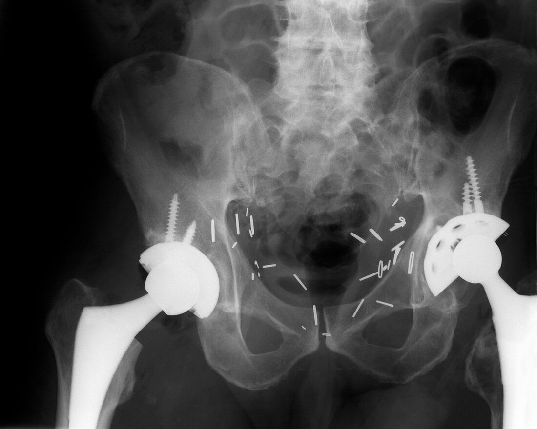 Double Hip Replacement