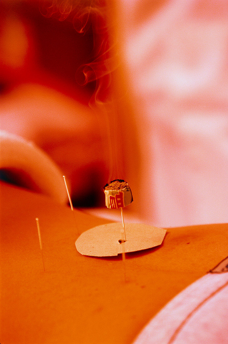 Moxibustion being carried out on patient's back
