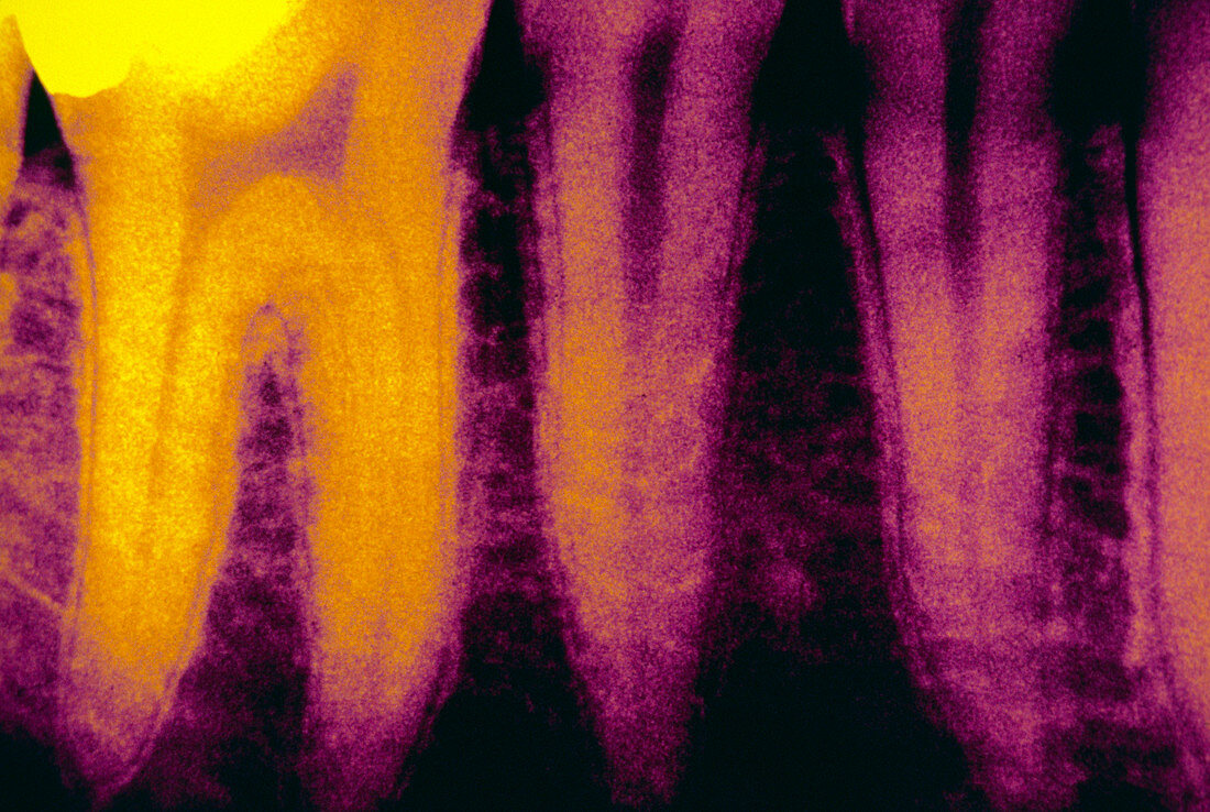Dental X-ray of teeth roots and filling
