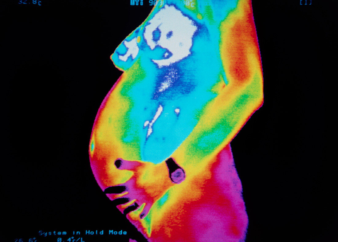 Thermogram of pregnant woman