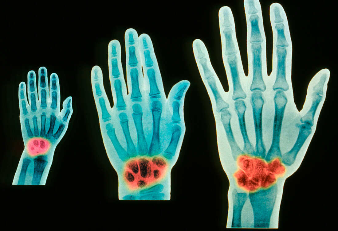 Hand development,X-ray
