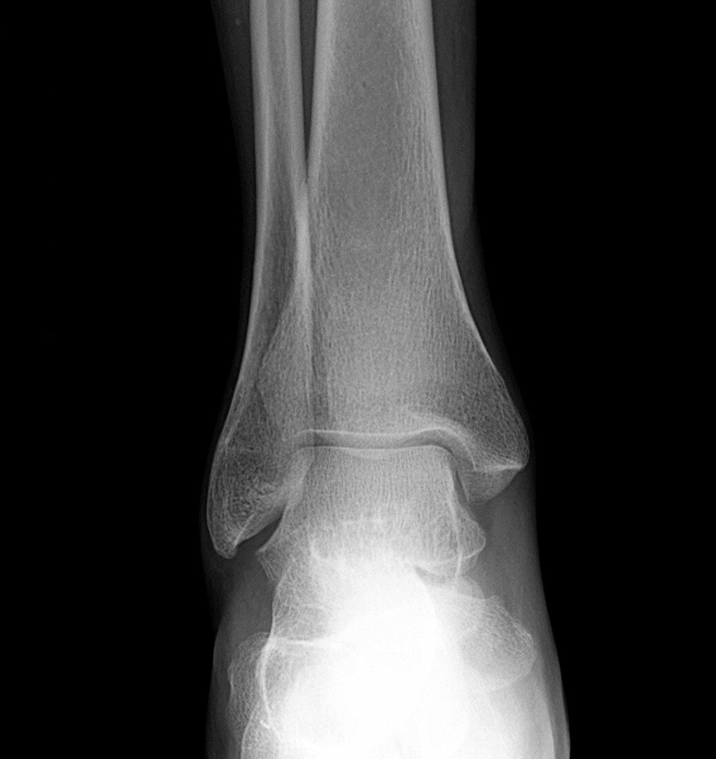 Normal Frontal X-ray of the Ankle